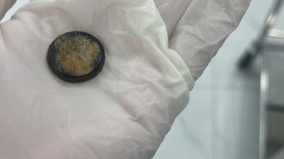 Un niño casi sufre una perforación esofágica y un anciano presenta un absceso hepático en estado crítico por atragantarse con un objeto extraño