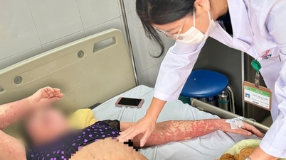ស្ត្រី​មាន​អាការ​រមាស់​ខ្លាំង និង​ហើម​មុខ​បន្ទាប់​ពី​លេប​ថ្នាំ