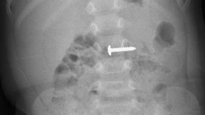 Salva al niño que se tragó un tornillo afilado