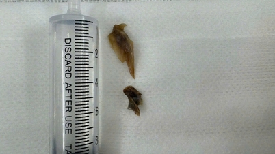 Fragmentos óseos encontrados en pulmones de hombre durante más de dos años