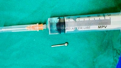 Cô gái nuốt chiếc khuyên lưỡi khi ăn bữa tối