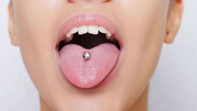 สาววัย 19 ปี ถูกส่งโรงพยาบาล หลังกลืนน้ำลายเจาะลิ้น