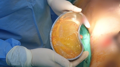 Rupture inattendue d'un implant mammaire pendant la grossesse