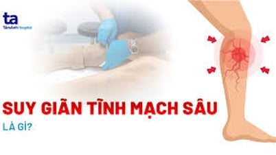 Bị suy giãn tĩnh mạch sâu nhưng phải đi làm liên tục, nên chữa thế nào?