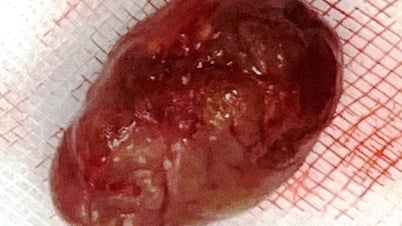 Phẫu thuật cắt bỏ thành công khối u trong tuyến mang tai hiếm gặp