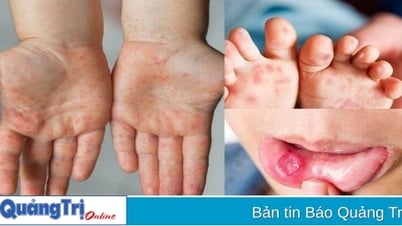 Gia tăng số ca mắc bệnh chân tay miệng