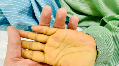 Cứu sống nữ bệnh nhân nhân có hàng tỷ virus viêm gan B trong máu