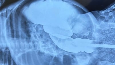 生後2ヶ月の女の子が稀な先天性大腸閉鎖症を患う