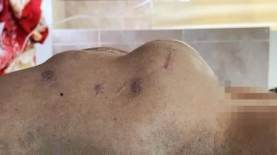 「ビール腹」だと思ったせいで死にかけた人がたくさんいる