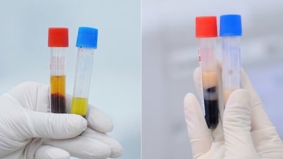 Untersuchung zeigt milchiges Serum, ein Warnsignal für Schlaganfallrisiko
