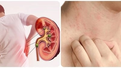 5 premiers signes d'insuffisance rénale que vous devez connaître