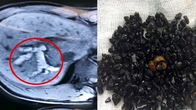 Ký sinh trùng chui lên đường mật nguy hiểm ra sao?