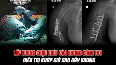 Phu Tho: Cam Khe District Medical Center successfully performed bone graft surgery to treat artificial joints
