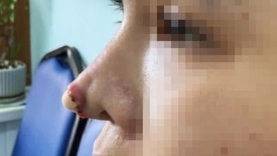 HCMC : deux autres femmes souffrent de graves conséquences après une rhinoplastie