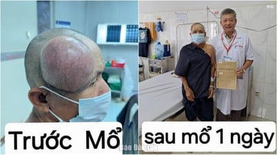 頭部に「巨大」腫瘍を持つ患者の手術が成功