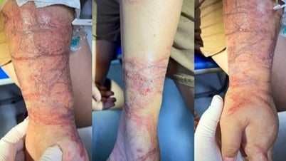 Vòng tay ôm sứa biển trong suốt, bé gái bị bỏng rát chằng chịt 2 cẳng tay
