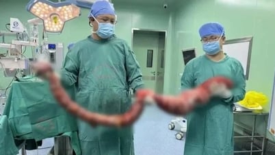 Un homme a subi une intervention chirurgicale pour retirer 20 kg de masse intestinale après ne pas avoir déféqué pendant 4 mois