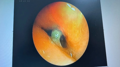 高齢患者の気管支から鋭い骨片を除去する内視鏡手術
