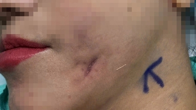 جاءت امرأة من هانوي إلى مدينة هوشي منه طلبًا للمساعدة لأن خدها بدأ فجأة ينزف صديدًا.