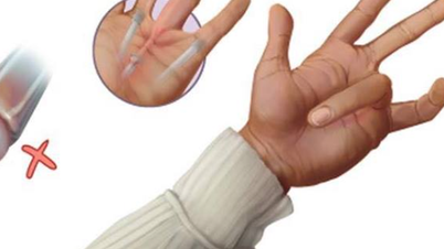 Hội chứng 'ngón tay lò xo' là gì?