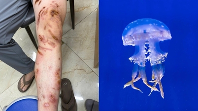 Daños en la piel por picaduras de medusas al nadar en el mar