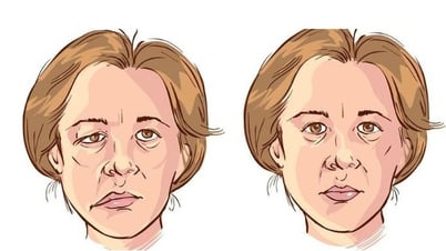 Простуда, инсульт: риск развития периферического паралича лицевого нерва