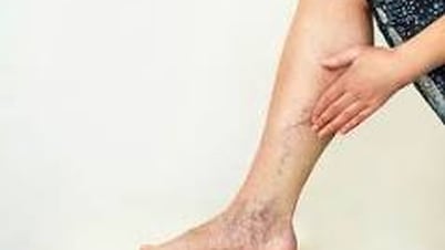 អ្នកដែលមានសរសៃ varicose គួរដើរ?