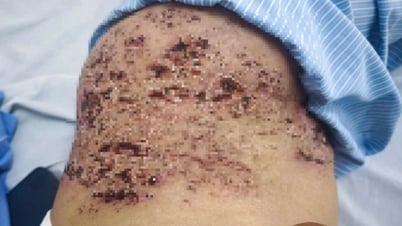 Da như tổ ong sau khi đắp đậu xanh chữa zona thần kinh