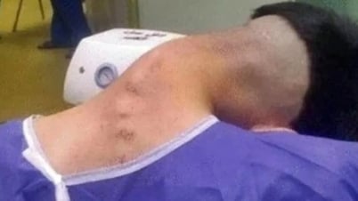 Nam thanh niên mắc "hội chứng đầu gục" do lạm dụng chất gây nghiện