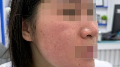 Hết trị bách bệnh, lại rước họa vì dùng nước cốt chanh trị mụn