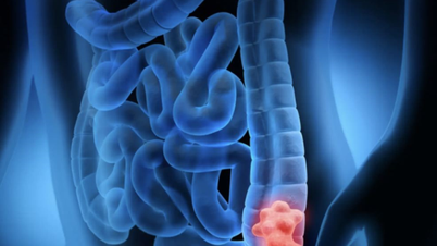Thought it was food poisoning, turned into cancer