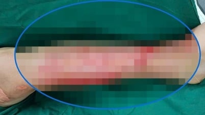 Liên tiếp nhiều người gặp biến chứng nguy hiểm do đắp 'thuốc lá' chữa bỏng