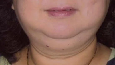 Dùng corticoid kéo dài, nguy cơ gây ra bệnh cushing