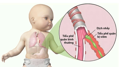 Does it have any effect if my baby continuously takes antibiotics to treat bronchitis?