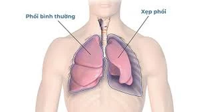 Bị xẹp phổi có hồi phục được không?