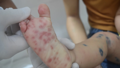 Hà Nội ghi nhận 112 trường hợp mắc tay chân miệng trong một tuần