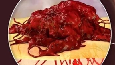 Mắc ung thư bị chẩn đoán sai, phải cắt một phần dương vật