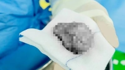 여러 날 동안 음낭에 통증이 있어 병원에 가서 검사를 받아보니 고환괴사라는 사실을 발견했습니다.