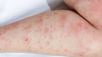 Mưa lớn kéo dài nhiều ngày, hàng ngàn người ở TPHCM đi khám bệnh da liễu