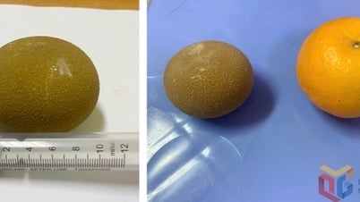 Surgery to remove bladder stones as big as oranges from the patient's body