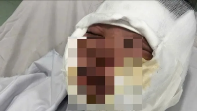 Ca Mau: Mini-Gastank explodierte während einer Party zum Todestag, viele Menschen wurden ins Krankenhaus eingeliefert