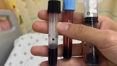 Máu bé gái chuyển màu nâu sau bữa trưa, cảnh báo thói quen nấu ăn nguy hiểm