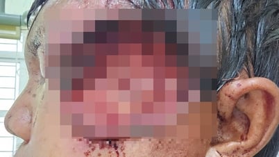 除草剤を使用して傷口を洗浄したところ、男性患者の顔面が壊死し、ウジ虫感染が起きた。