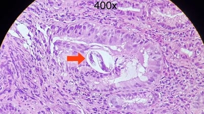 ホーチミン市の病院で、珍しい糞線虫症の症例が4件、予期せず発見される