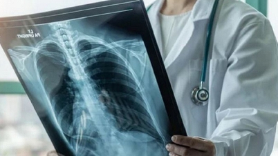 AI can effectively screen for lung cancer