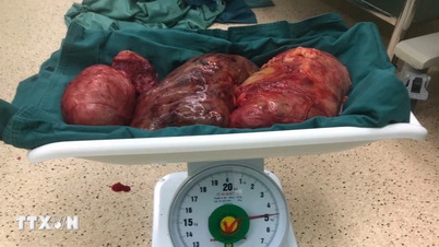 عملية جراحية لإزالة ورم ليفي يزن حوالي 5 كجم لدى مريضة تبلغ من العمر 56 عامًا