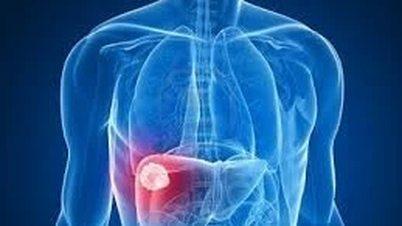 What effects does liver calcification have on health?