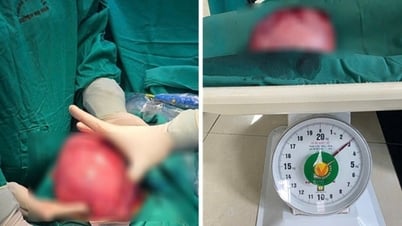 TTYT Hạ Hòa phẫu thuật thành công khối u xơ tử cung kích thước lớn hiếm gặp