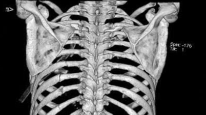 Trèo cây chôm chôm ngã từ độ cao 4 mét xuống đất, người phụ nữ nguy kịch