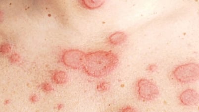Sau Covid-19, tỷ lệ mắc bệnh tự miễn tăng cao